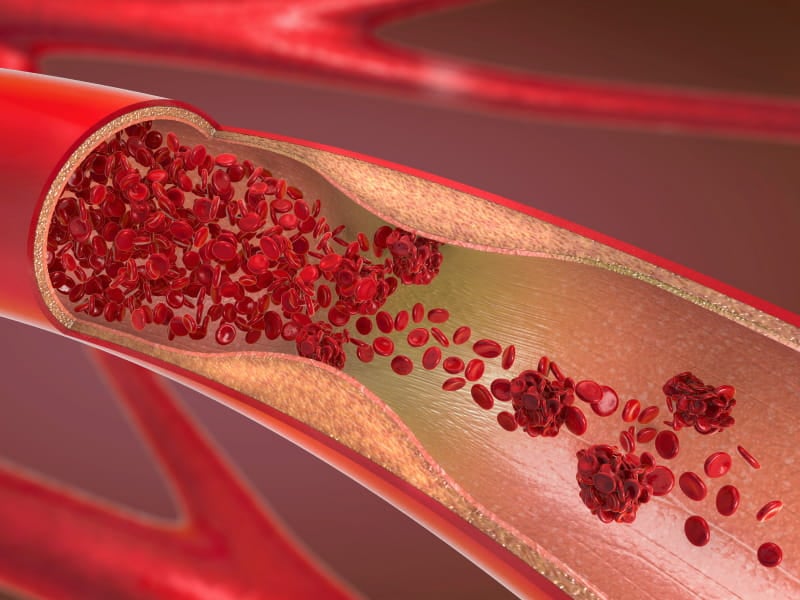 Diets low in cholesterol can help reduce heart disease, stroke risk