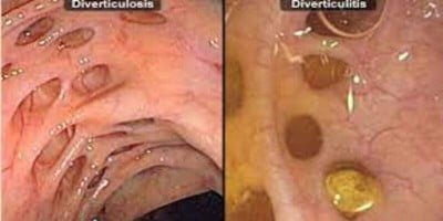 Diverticulosis vs. Diverticulitis