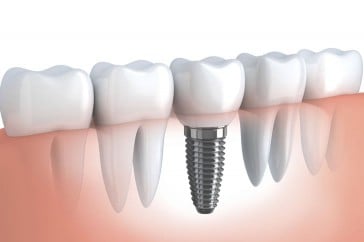 How to Choose the Best Option for Replacing Missing Teeth